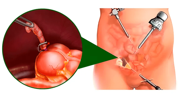 Apendicectomía laparoscópica