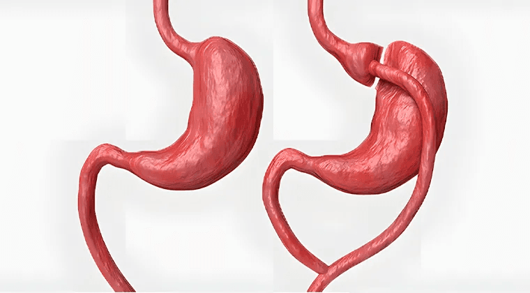 Cirugía de bypass gástrico en Y de Roux Laparoscópico