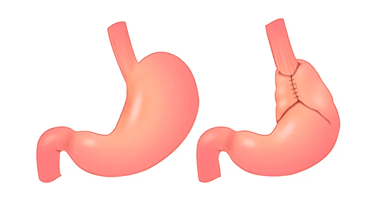 Cirugía antirreflujo (Funduplicatura laparoscópica)