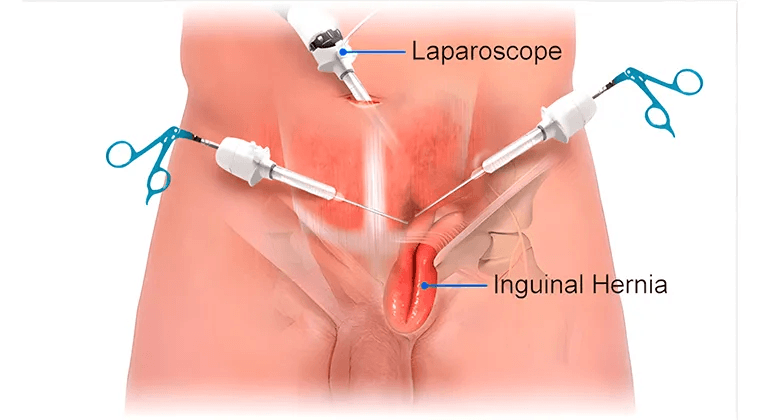 Cirugía de hernias de pared abdominal