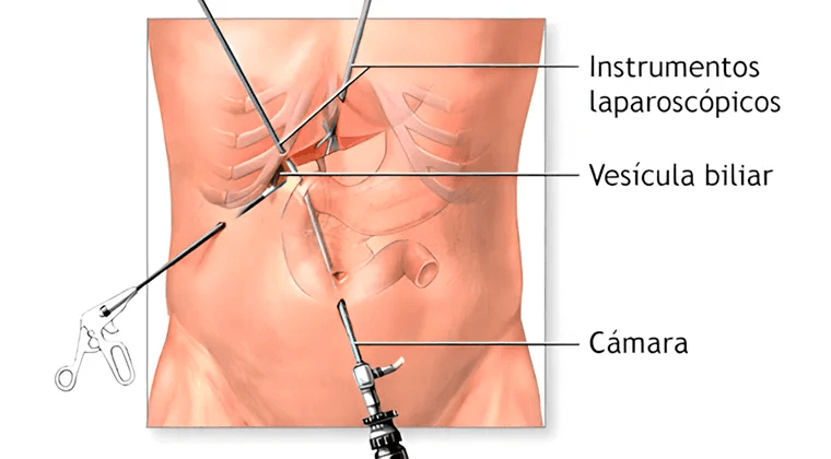 Colecistectomía laparoscópica (Cirugía de vesícula biliar)