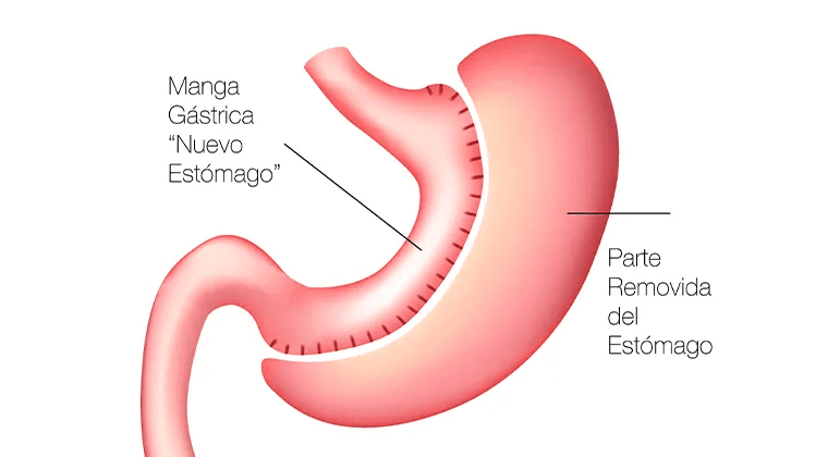 Gastrectomía vertical (manga gástrica) Laparoscópica